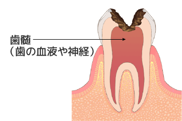 C3：歯髄炎